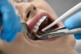 Surgical Extraction